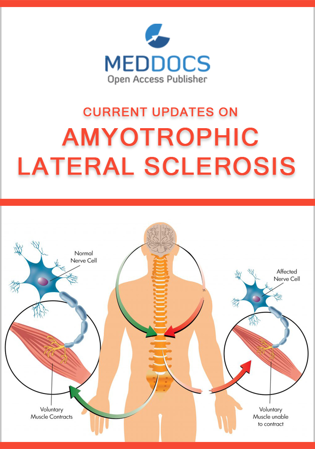 Amyotrophic Lateral Sclerosis